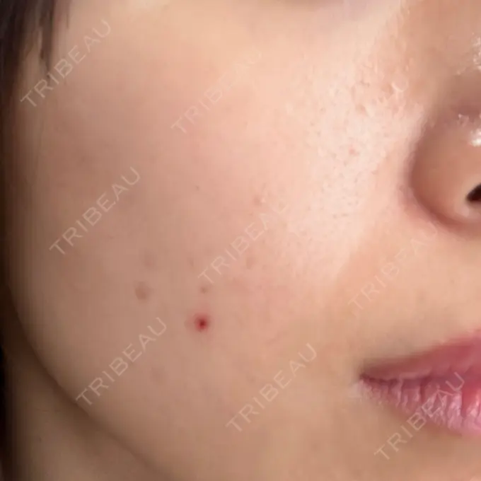 エレクトロポレーション / 毛穴洗浄（ハイドラフェイシャルなど） 心斎橋KT美容クリニック DAY 11 メイン用