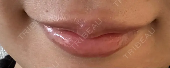 ヒアルロン酸注入（唇） / ボトックス（口角） 銀座美容外科クリニック 銀座院 DAY 2 メイン用