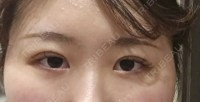 二重埋没 HAAB×DREAM BEAUTY CLINIC 大阪梅田院 DAY 3 メイン用