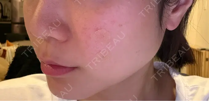 サブシジョン コスメディカルクリニック シンシア 渋谷院 DAY 0 メイン用