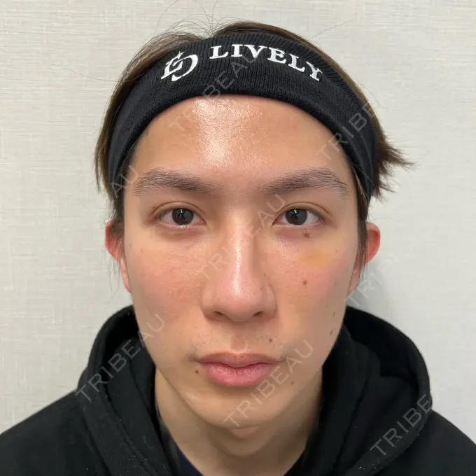 クマ治療 ライブリークリニック 船橋院 AFTER メイン用