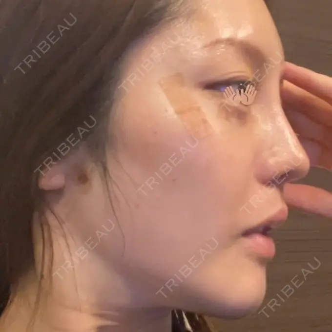 隆鼻術 / 鼻尖形成（切開） / 小鼻縮小（切開） / 軟骨移植 / 鼻修正 / 鼻孔縁挙上 / 鼻柱下降・鼻唇角形成（猫手術） eクリニック 金沢本院 DAY 34 メイン用