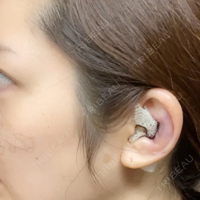 隆鼻術 / 鼻尖形成（切開） / 小鼻縮小（切開） / 軟骨移植 / 鼻修正 / 鼻孔縁挙上 / 鼻柱下降・鼻唇角形成（猫手術） eクリニック 金沢本院 DAY 3 メイン用