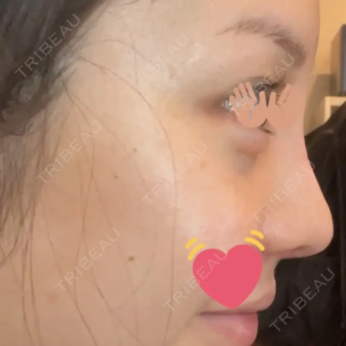 隆鼻術 / 鼻尖形成（切開） / 小鼻縮小（切開） / 軟骨移植 / 鼻修正 / 鼻孔縁挙上 / 鼻柱下降・鼻唇角形成（猫手術） eクリニック 金沢本院 DAY 14 メイン用