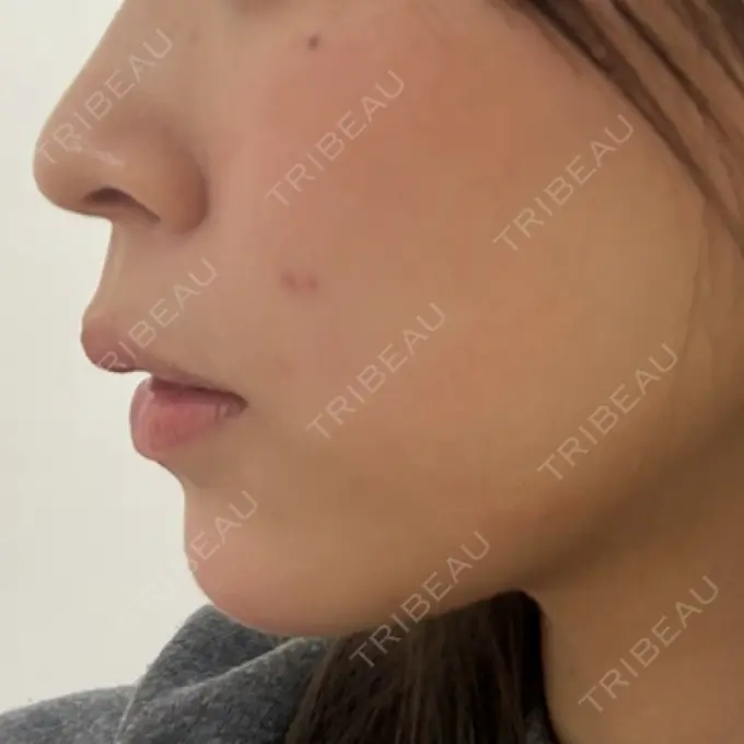 RF（高周波）たるみ治療 RIVER CLINIC（リバークリニック） DAY 2 メイン用