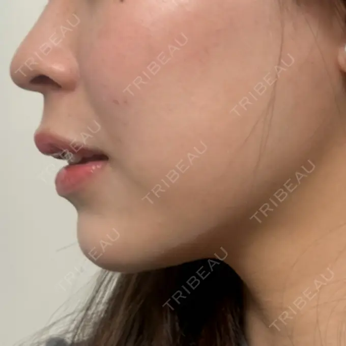 RF（高周波）たるみ治療 RIVER CLINIC（リバークリニック） AFTER メイン用