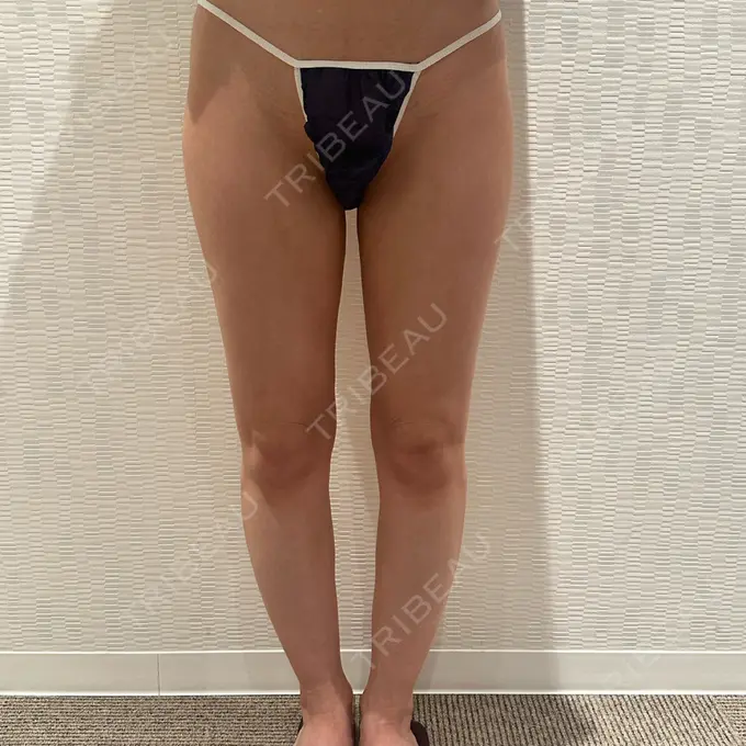 脂肪吸引（脚） / 脂肪吸引（お尻） Mods Clinic（モッズクリニック） 名古屋院 AFTER メイン用