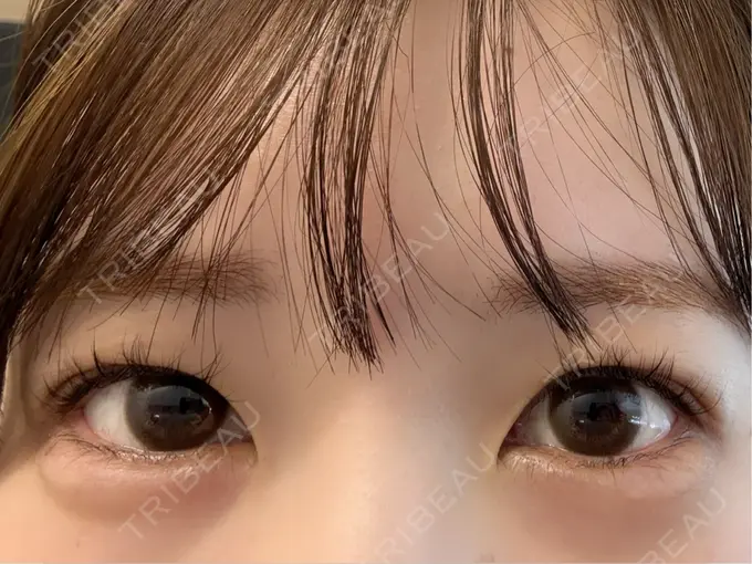 ヒアルロン酸注入（涙袋） / ヒアルロン酸注入（唇） / ボトックス（口角） ルラ美容クリニック 渋谷本院 AFTER メイン用