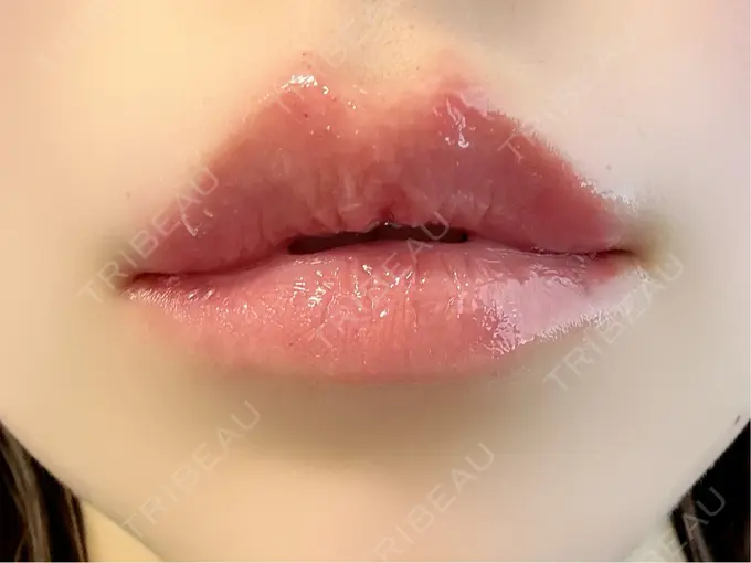 ヒアルロン酸注入（涙袋） / ヒアルロン酸注入（唇） / ボトックス（口角） ルラ美容クリニック 渋谷本院 DAY 0 メイン用