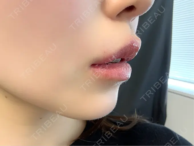 ヒアルロン酸注入（涙袋） / ヒアルロン酸注入（唇） / ボトックス（口角） ルラ美容クリニック 渋谷本院 DAY 0 メイン用