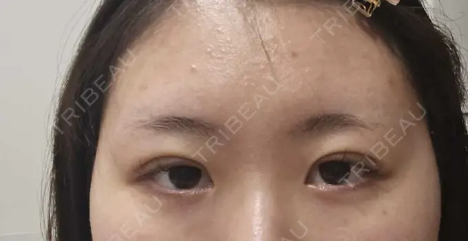 二重埋没 HAAB×DREAM BEAUTY CLINIC 大阪梅田院 DAY 6 メイン用