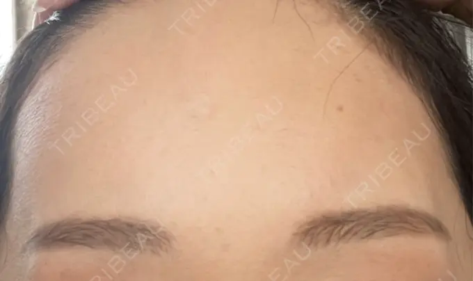 シワ取りボトックス / ボトックス（眉間） / ボトックス（額） / その他（鼻） カジュアルクリニック 平塚院 AFTER メイン用