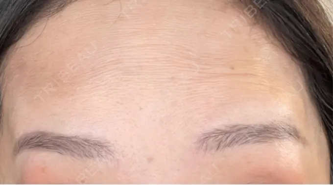 シワ取りボトックス / ボトックス（眉間） / ボトックス（額） / その他（鼻） カジュアルクリニック 平塚院 DAY 10 メイン用