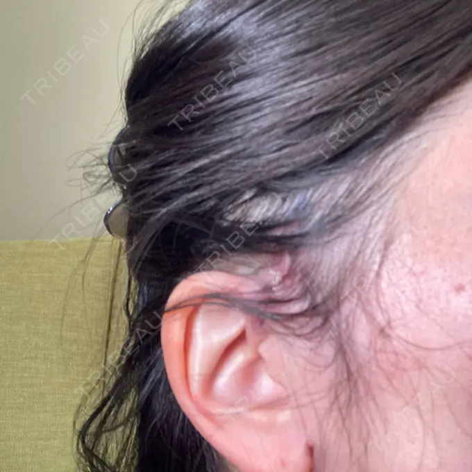 脂肪吸引（顔） / 切開リフト GRACY TOKYO CLINIC【グレイシートウキョウクリニック】 DAY 2 メイン用