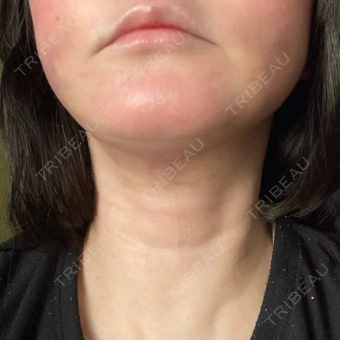 脂肪吸引（顔） / 切開リフト GRACY TOKYO CLINIC【グレイシートウキョウクリニック】 DAY 2 メイン用