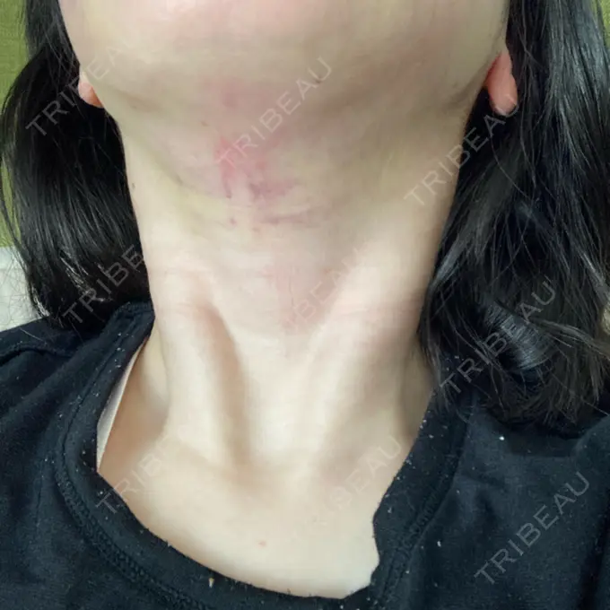 脂肪吸引（顔） / 切開リフト GRACY TOKYO CLINIC【グレイシートウキョウクリニック】 DAY 2 メイン用