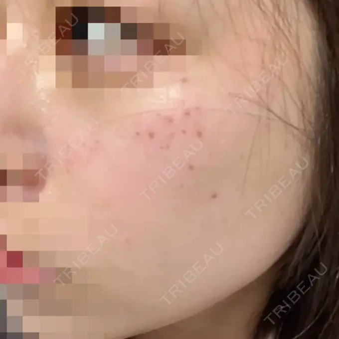 エレクトロポレーション / ピーリング（ハリ・ツヤ） / ルメッカ Otus Clinic 【オータスクリニック】 DAY 0 メイン用