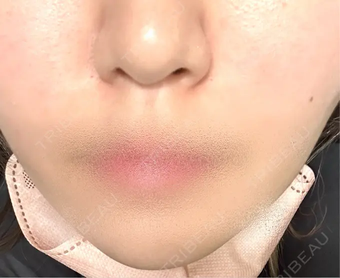 その他（口元） フィラークリニック 新宿院 DAY 0 メイン用