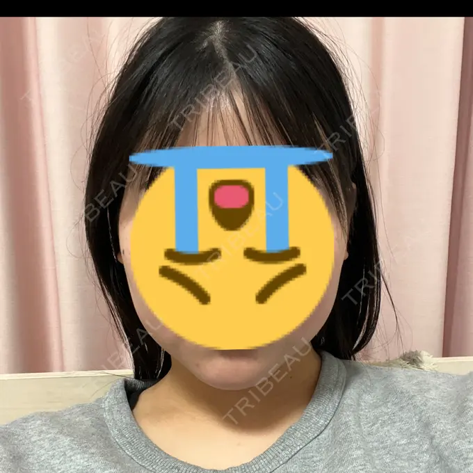 RF（高周波）たるみ治療 RIVER CLINIC（リバークリニック） DAY 14 メイン用