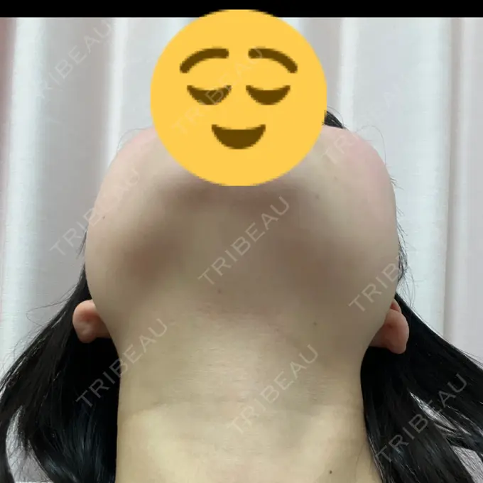 RF（高周波）たるみ治療 RIVER CLINIC（リバークリニック） DAY 14 メイン用