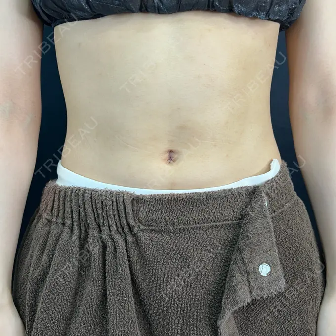 へそ形成 藤・ナチュレ美容クリニック 銀座院 AFTER メイン用