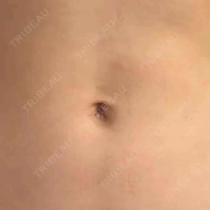 へそ形成 藤・ナチュレ美容クリニック 銀座院 DAY 28 メイン用