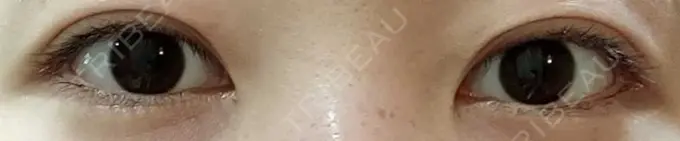 二重埋没 聖心美容クリニック 六本木院 DAY 16 メイン用