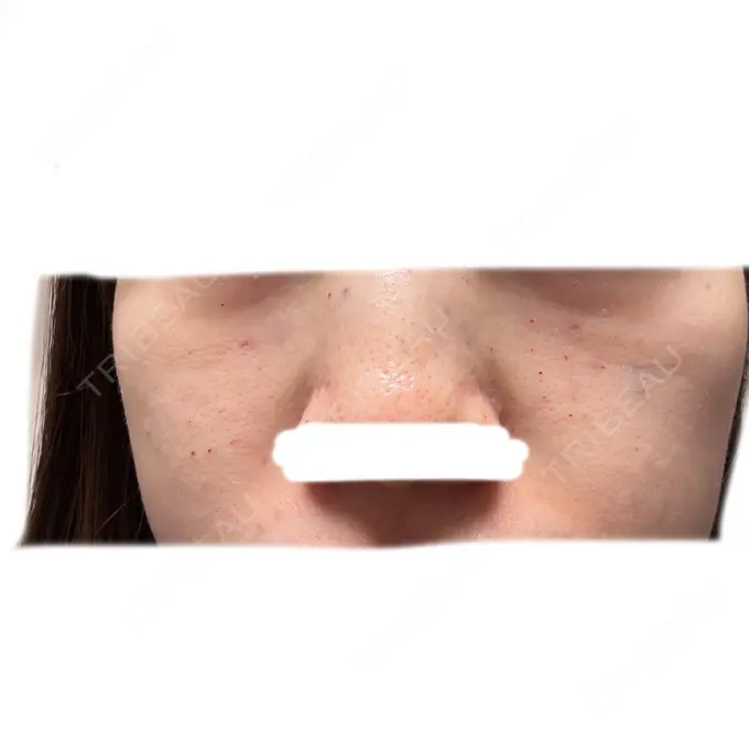 水光注射（ハリ・美肌） / 肌育注射（ジュベルックなど） / 毛穴洗浄（ハイドラフェイシャルなど） オラクル美容皮膚科 名古屋院 DAY 0 メイン用