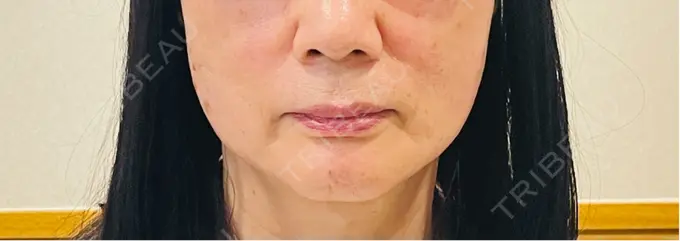 糸リフト MAクリニック 心斎橋 DAY 0 メイン用