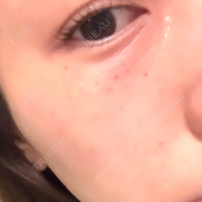 水光注射（ハリ・美肌） 筋肉・美容クリニック AFTER メイン用