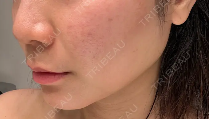 サブシジョン コスメディカルクリニック シンシア 渋谷院 AFTER メイン用