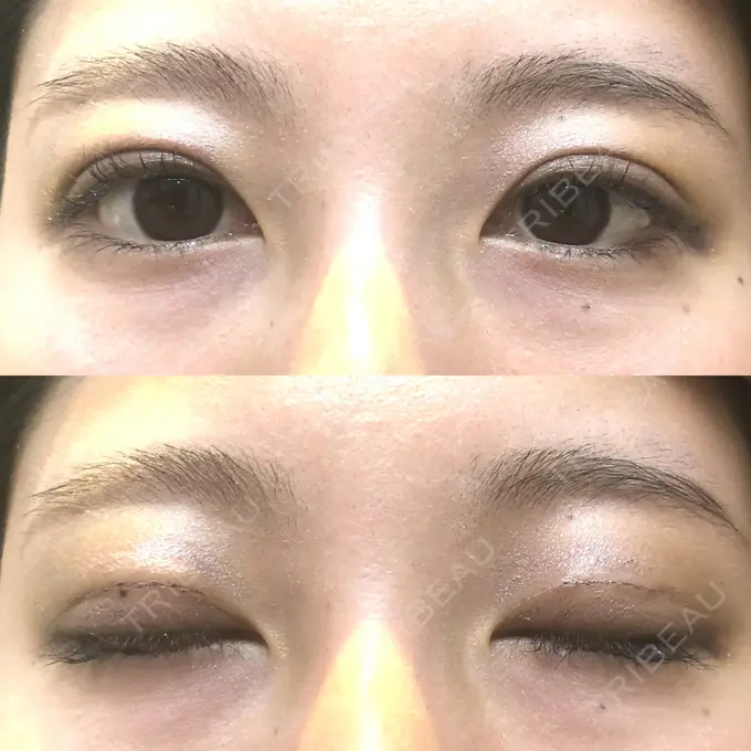 二重埋没 MIYAフェイスクリニック DAY 6 メイン用