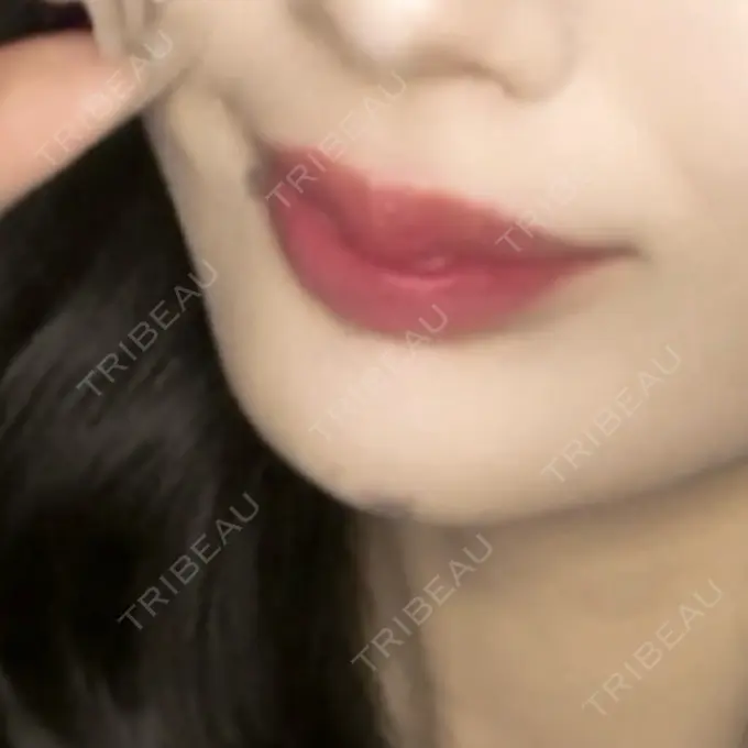 ボトックス（ふくらはぎ） / ヒアルロン酸注入（唇） / ボトックス（口角） ルヴィクリニック イオンドーム前院 AFTER メイン用