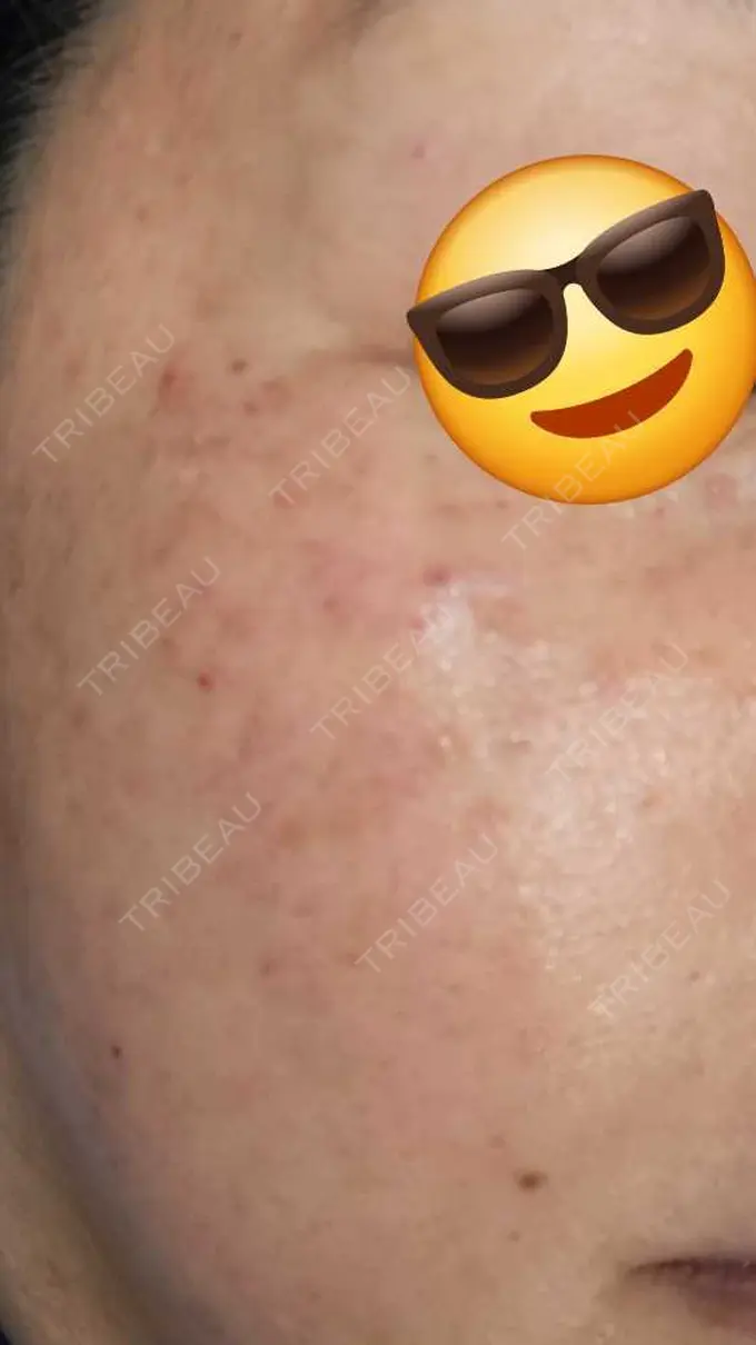 水光注射（ハリ・美肌） しんゆり美容健康クリニック DAY 0 メイン用