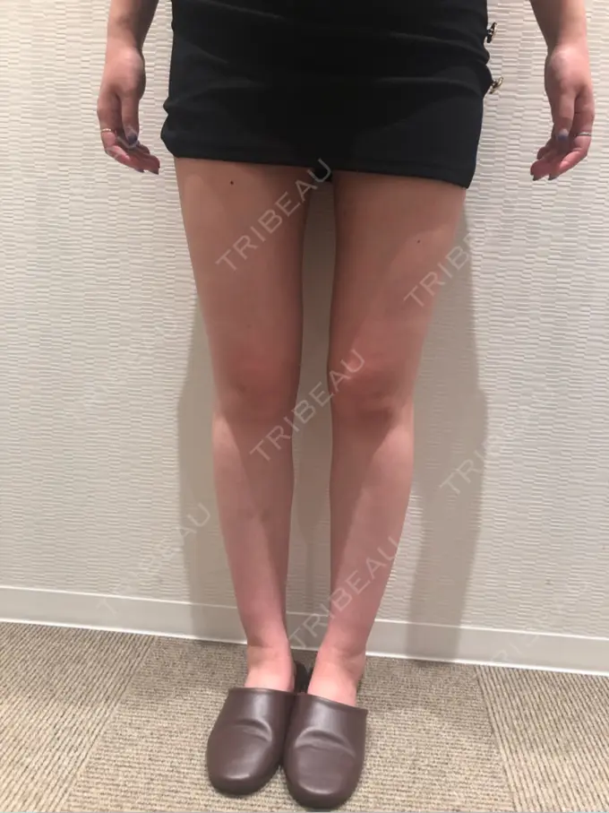 脂肪吸引（脚） / 豊胸（脂肪注入） Mods Clinic（モッズクリニック） 名古屋院 AFTER メイン用