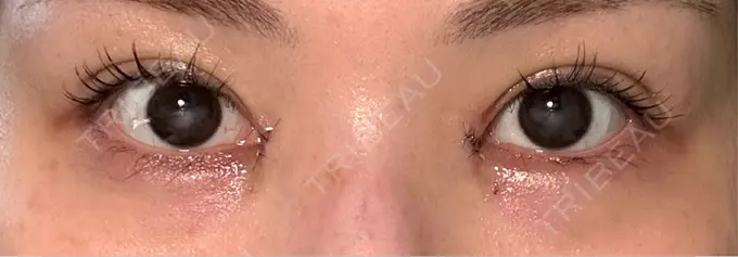 二重埋没 / 目頭切開 / その他（目元） eクリニック 福岡院 DAY 2 メイン用