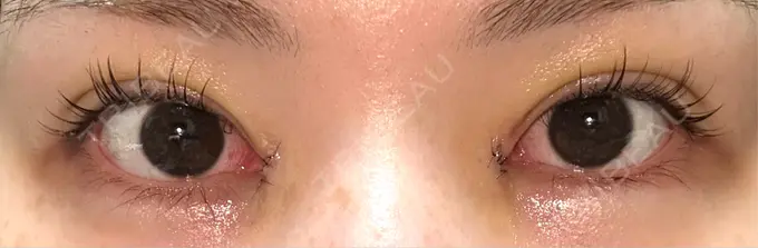 二重埋没 / 目頭切開 / その他（目元） eクリニック 福岡院 DAY 4 メイン用