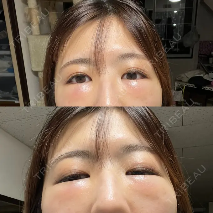 クマ治療 / 脂肪注入（目の下） 湘南美容クリニック 池袋東口院 DAY 1 メイン用