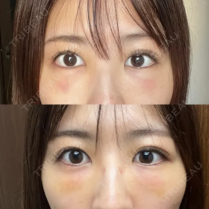 クマ治療 / 脂肪注入（目の下） 湘南美容クリニック 池袋東口院 DAY 1 メイン用