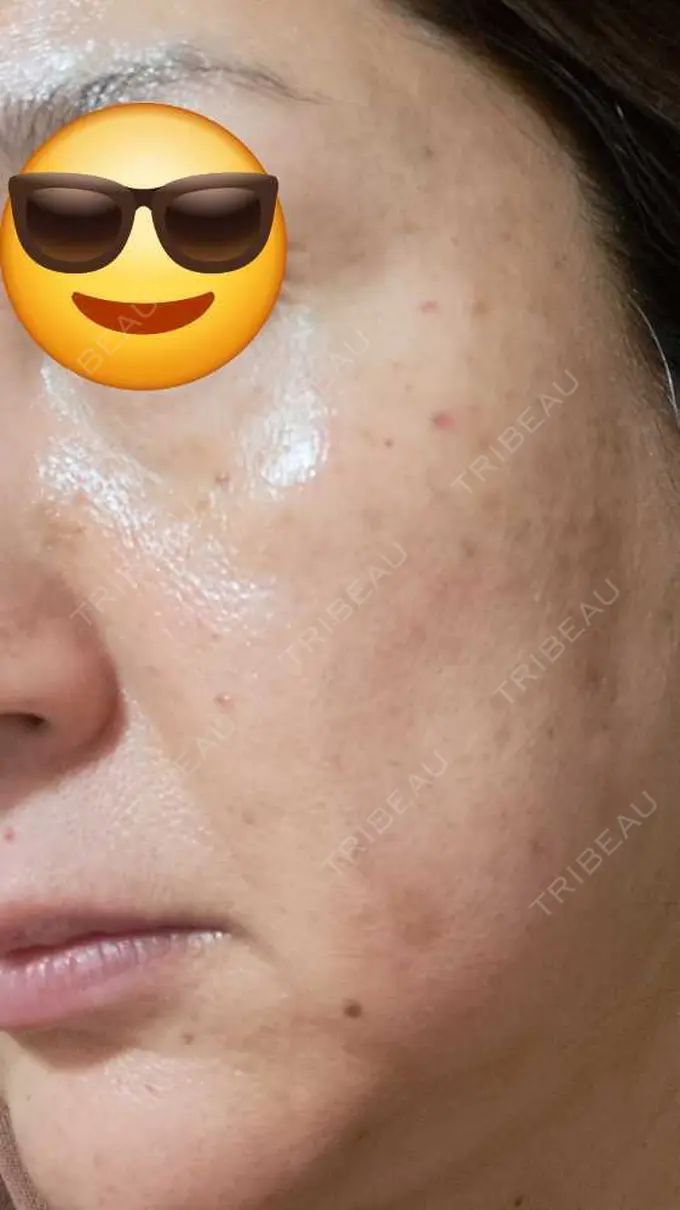 水光注射（ハリ・美肌） しんゆり美容健康クリニック DAY 1 メイン用