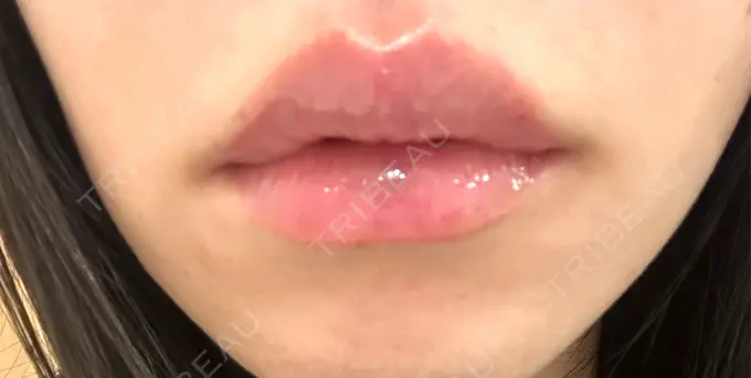 ヒアルロン酸注入（唇） オラクル美容皮膚科 福岡天神院 AFTER メイン用