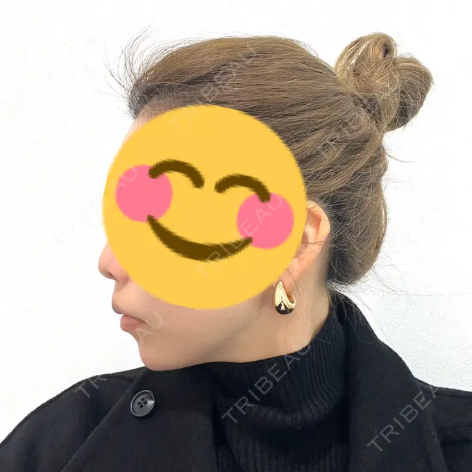 ボトックス（あご） / ヒアルロン酸注入（あご） TCB東京中央美容外科 仙台駅前院 AFTER メイン用