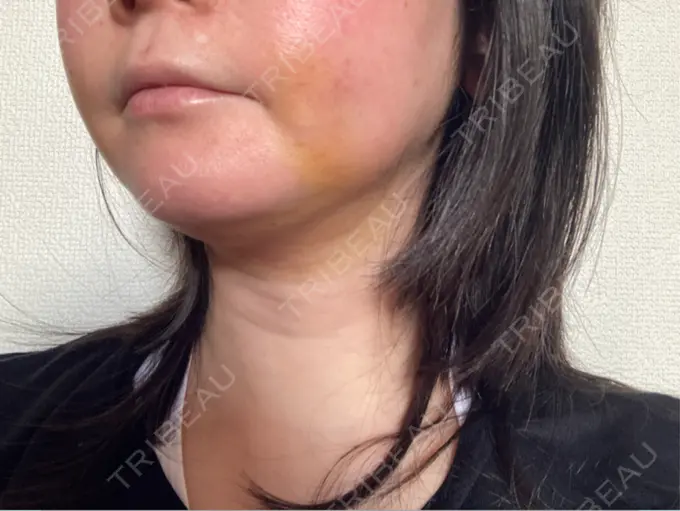 脂肪吸引（顔） / 切開リフト GRACY TOKYO CLINIC【グレイシートウキョウクリニック】 DAY 5 メイン用