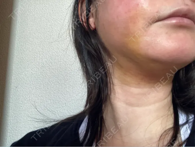 脂肪吸引（顔） / 切開リフト GRACY TOKYO CLINIC【グレイシートウキョウクリニック】 DAY 5 メイン用