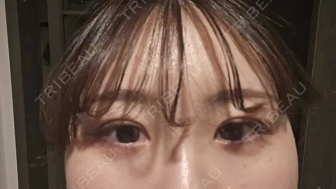 二重埋没 HAAB×DREAM BEAUTY CLINIC 大阪梅田院 DAY 8 メイン用