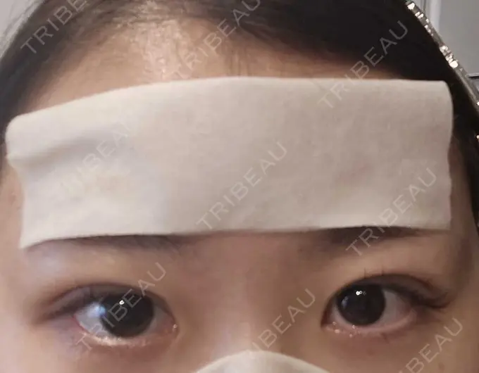 二重埋没 HAAB×DREAM BEAUTY CLINIC 大阪梅田院 DAY 9 メイン用