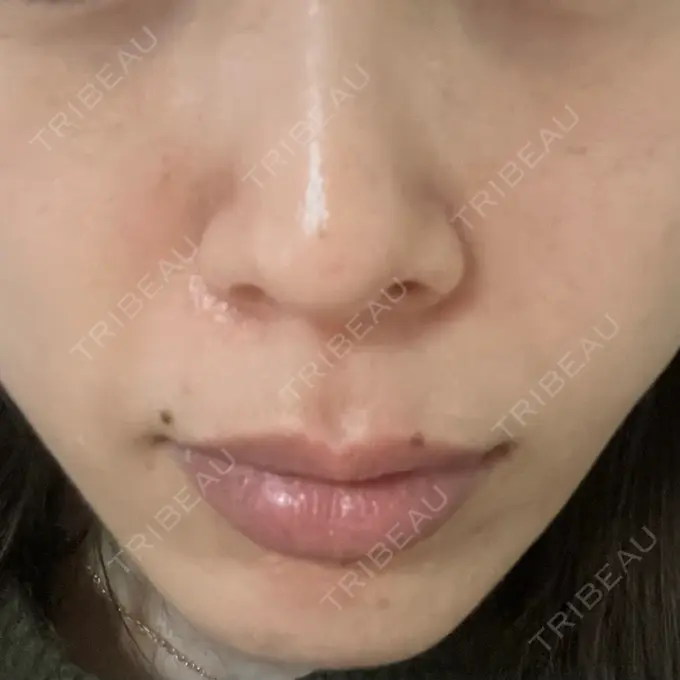 ピーリング（ハリ・ツヤ） 椿クリニック 名古屋院 AFTER メイン用