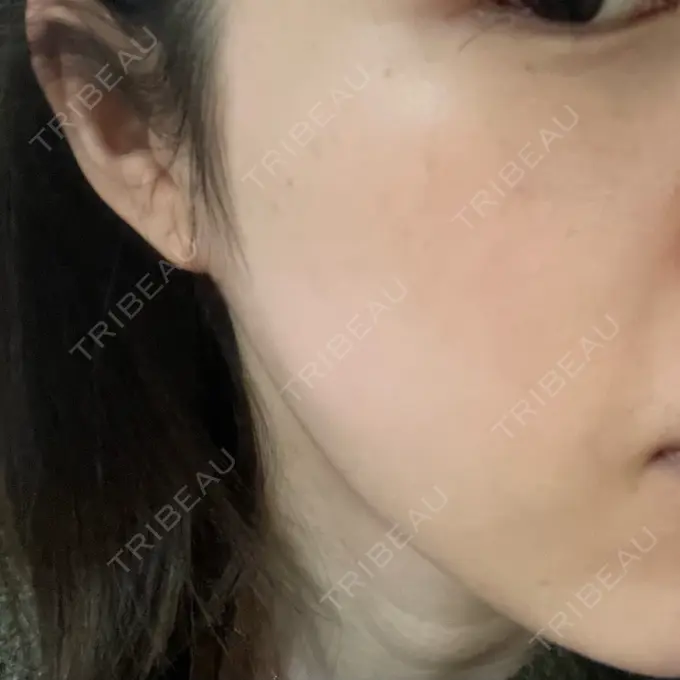 ピーリング（ハリ・ツヤ） 椿クリニック 名古屋院 DAY 1 メイン用