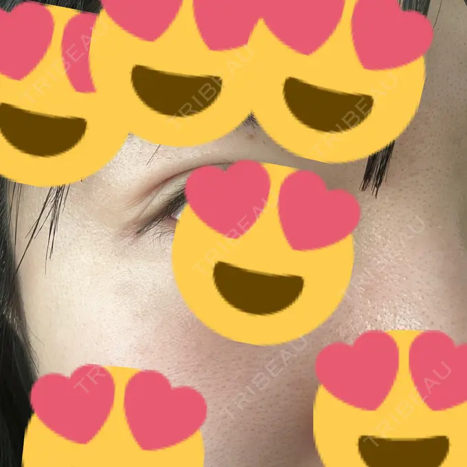 糸リフト / 脂肪吸引（顔） / 脂肪吸引（二の腕） / 上まぶたたるみ取り / 上まぶたの脂肪取り / ジョールファット除去 / 脂肪吸引（肩） / ボトックス（エラ・小顔） 湘南美容クリニック 秋葉原院 AFTER メイン用