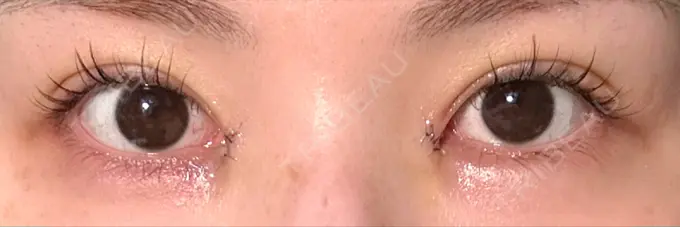 二重埋没 / 目頭切開 / その他（目元） eクリニック 福岡院 DAY 6 メイン用